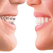 Invisalign Braces