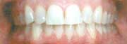 Overbite After Photos Overbite After Photos