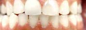 Gapped Teeth After Photos Gapped Teeth After Photos