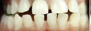 Gapped Teeth Before Photos Gapped Teeth Before Photos